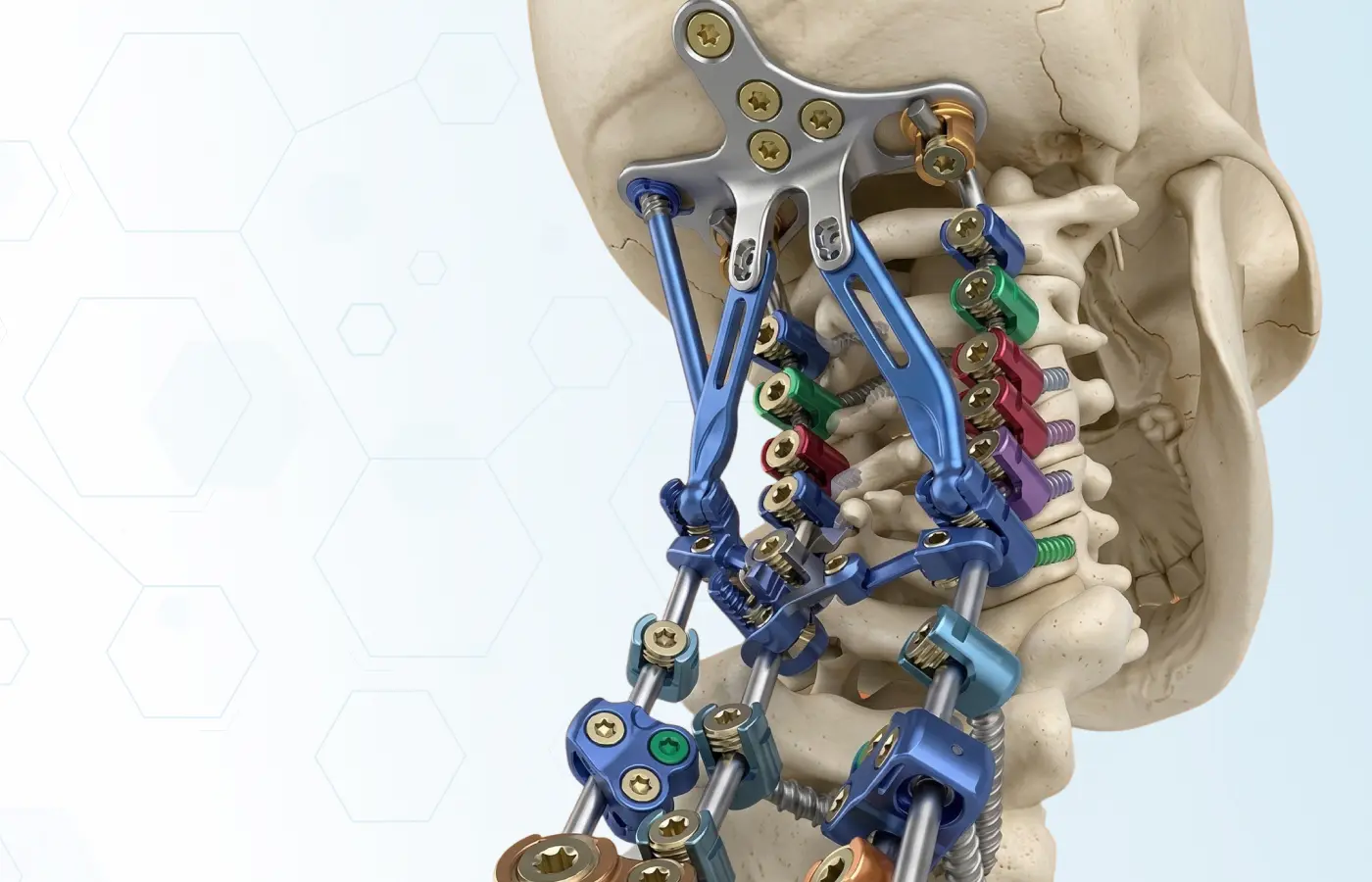 Implantes quirúrgicos